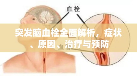 突发脑血栓全面解析，症状、原因、治疗与预防