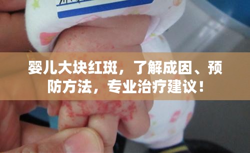 婴儿大块红斑，了解成因、预防方法，专业治疗建议！