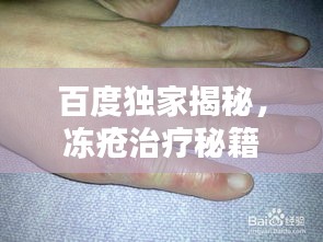 百度独家揭秘，冻疮治疗秘籍！